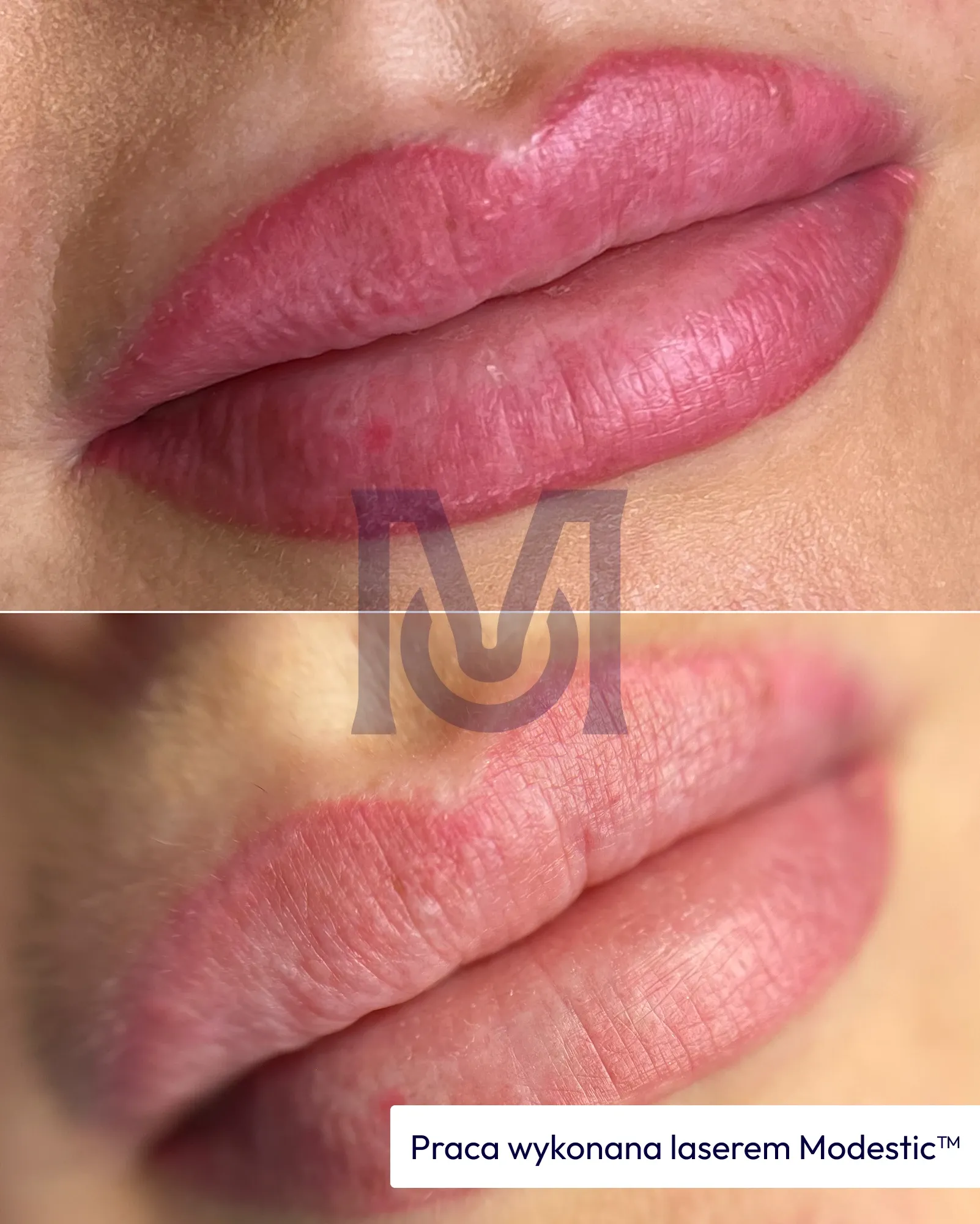 Usta z makijażem permanentnym przed i po usuwaniu laserem — pigment rozjaśniony.
