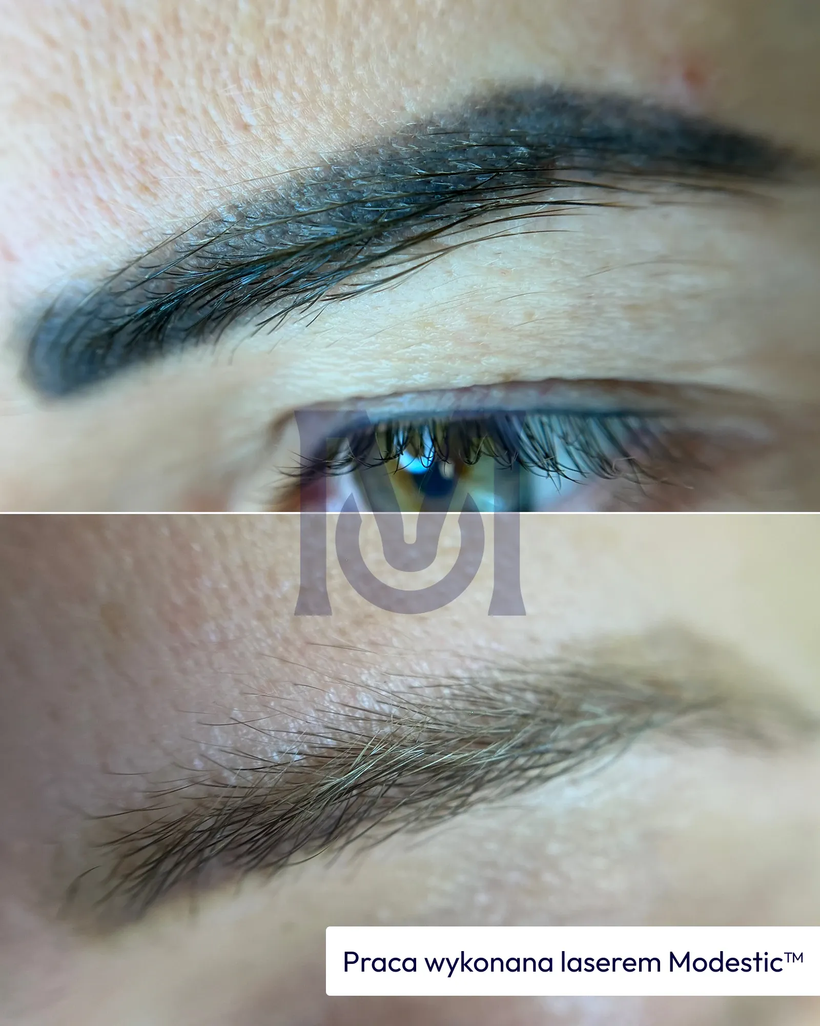 Brwi z makijażem permanentnym przed i po usuwaniu laserem — pigment wyraźnie rozjaśniony.